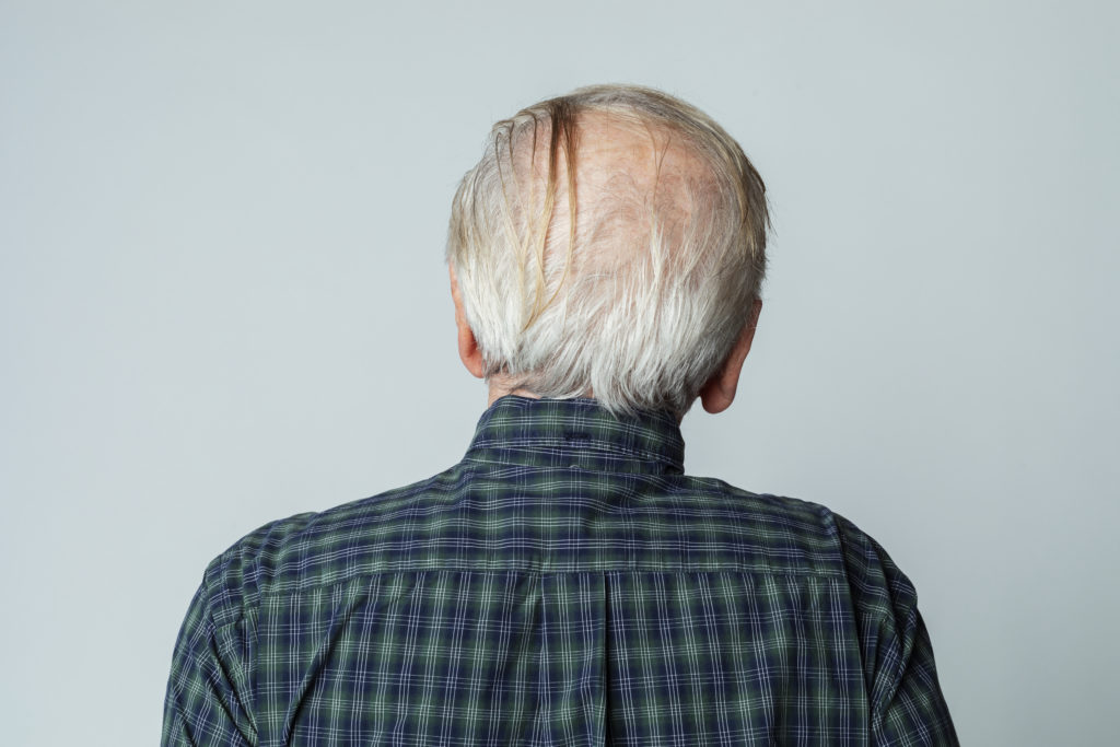 Rear view of a senior man crown balding